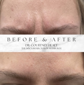 botox for unwanted wrinkles
