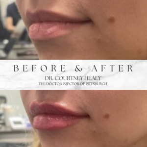 lip fillers by dr courtney healy