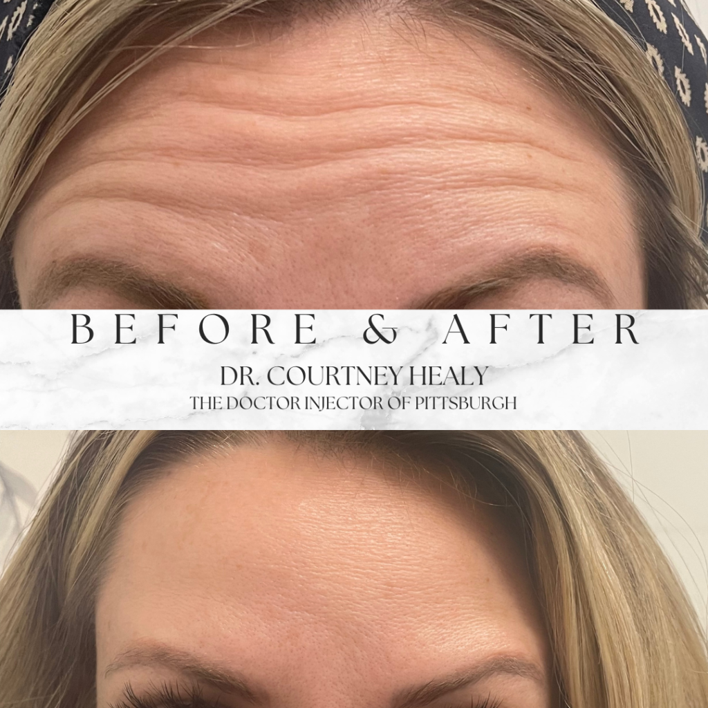 horizontal forehead lines before and after with botox