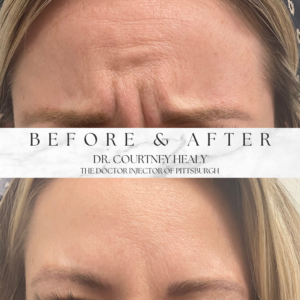 Glabellar lines before and after with botox