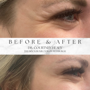 crow's feet before and after with botox at pittsburgh aesthetics