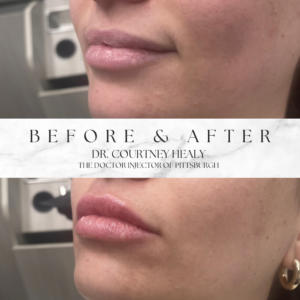 Pittsburgh Aesthetics before and after of lip filler